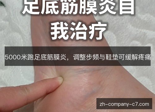 5000米跑足底筋膜炎,调整步频与鞋垫可缓解疼痛 5000米跑足底筋膜炎,调整步频与鞋垫可缓解疼痛